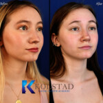 nasal tip rhinoplasty only