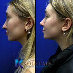 nasal tip rhinoplasty san diego