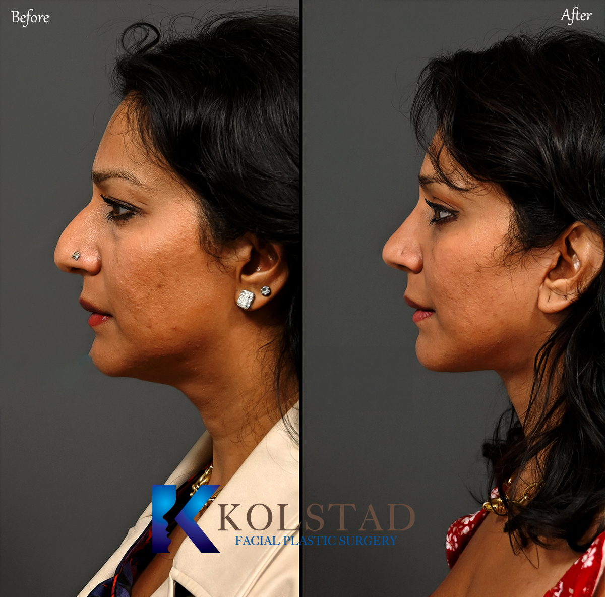 ultrasonic rhinoplasty before and after