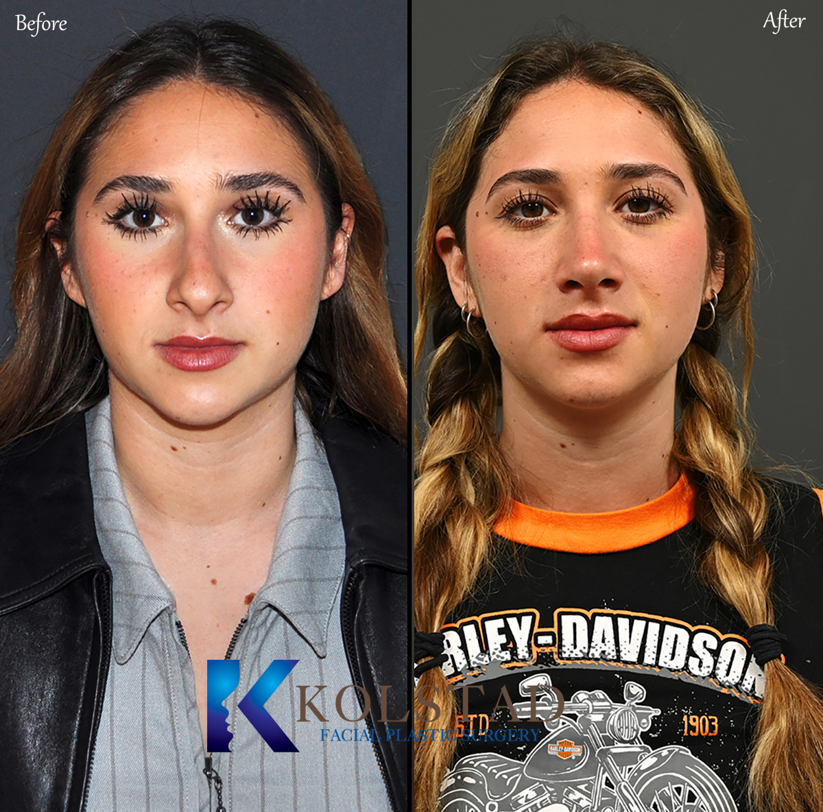 best ultrasonic rhinoplasty before and after