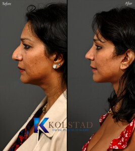 piezo rhinoplasty