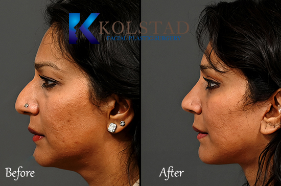 piezo rhinoplasty before and after