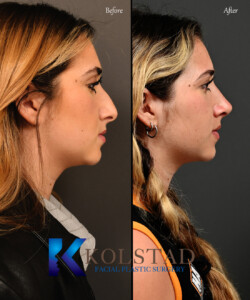 piezo rhinoplasty california