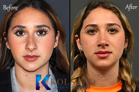 ultrasonic-rhinoplasty-san-diego