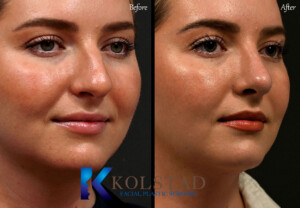 piezo rhinoplasty san diego before and after