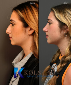 ultrasonic rhinoplasty