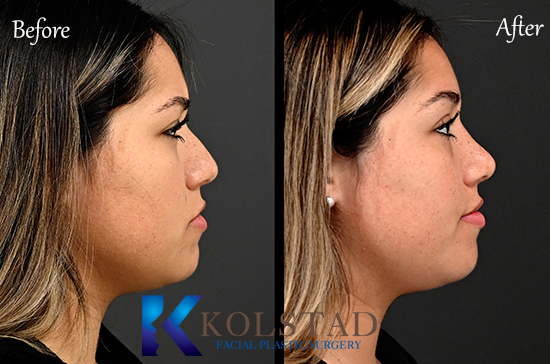 ultrasonic rhinoplasty before & after pictures