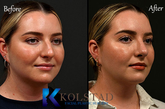 ultrasonic rhinoplasty before and after