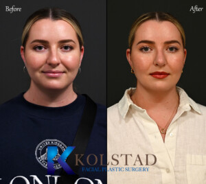 ultrasonic rhinoplasty california