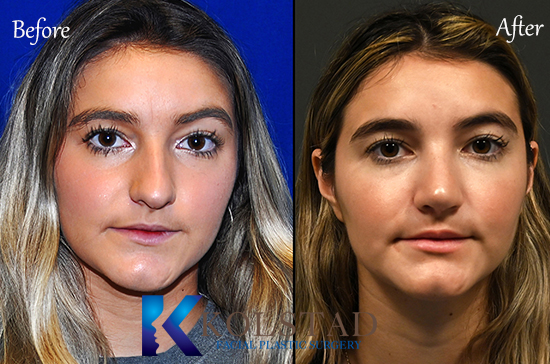 ultrasonic rhinoplasty photos