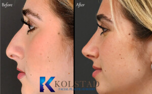 ultrasonic rhinoplasty san diego