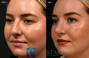 ultrasonice rhinoplasty befoer and after