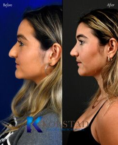 best rhinoplasty surgeon for big hump