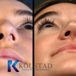 ultrasonic rhinoplasty for deviated septum