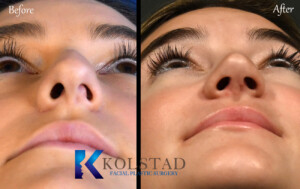 ultrasonic rhinoplasty for deviated septum