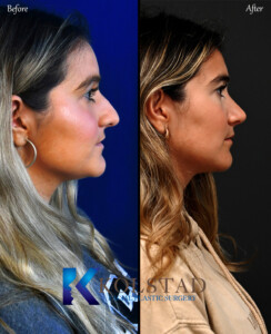 best piezo rhinoplasty surgeon