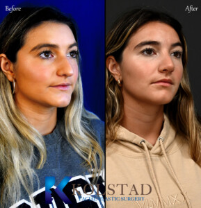 ultrasonic rhinoplasty san diego