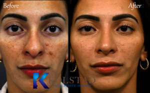 best ethnic rhinoplasty surgeon