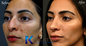 best hispanic nose job surgeon