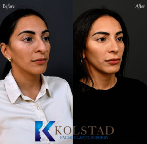 best hispanic rhinoplasty surgeon