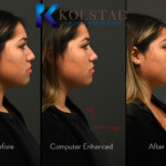 ethnic rhinoplasty california