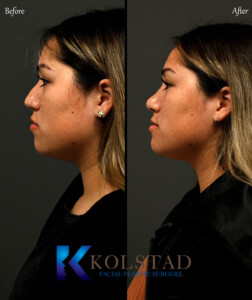 ethnic rhinoplasty