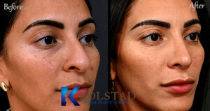 hispanic nose job before and after