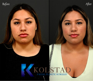 hispanic rhinoplasty