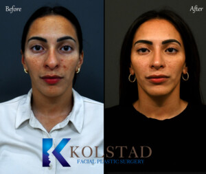 hispanic rhinoplasty before and after