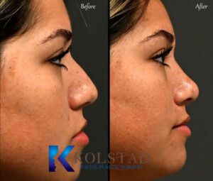 piezo rhinoplasty california