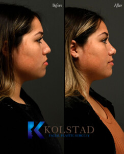 ultrasonic rhinoplasty