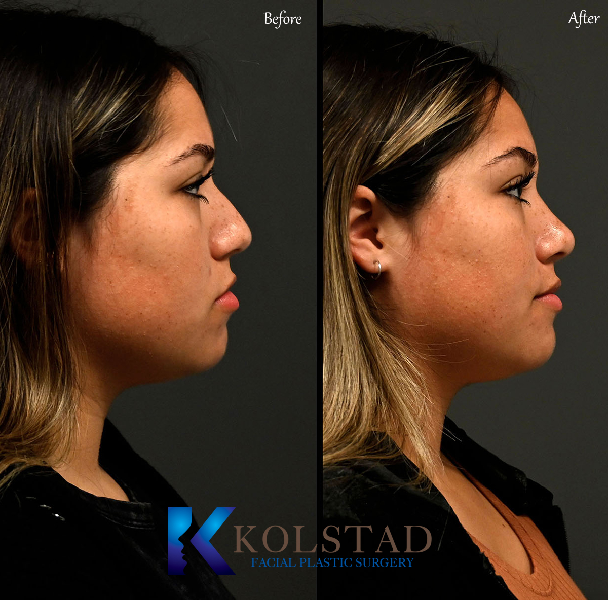 best ultrasonic rhinoplasty before and after