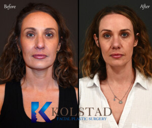 dorsal preservation rhinoplasty san diego