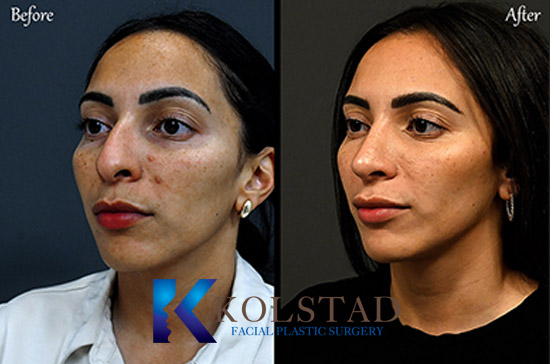  PIEZO RHINOPLASTY CALIFORNIA