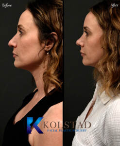 preservation rhinoplasty san diego