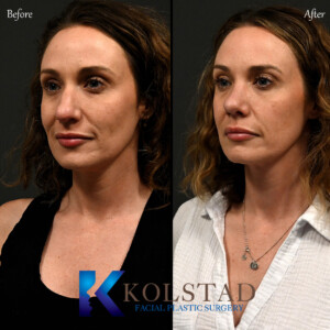 Dorsal Preservation Rhinoplasty