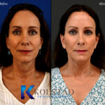 best facelift california