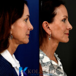 best facelift san diego