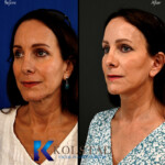 best facelift surgeon california