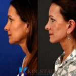 facelift la jolla