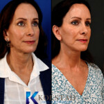 facelift near me