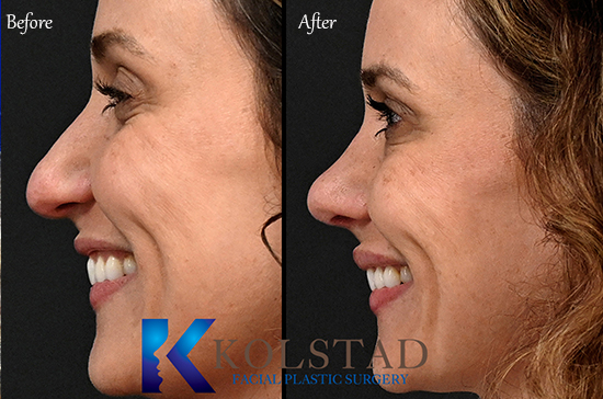 rhinoplasty for drooping tip