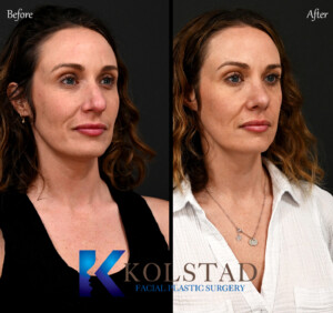 ultrasonic rhinoplasty expert