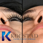 rhinoplasty scar