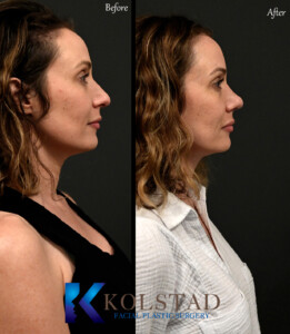 ultrasonic rhinoplasty