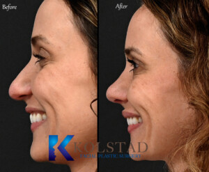 rhinoplasty for droopy tip