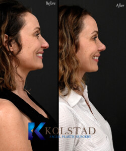 Rhinoplasty for Droopy Tip