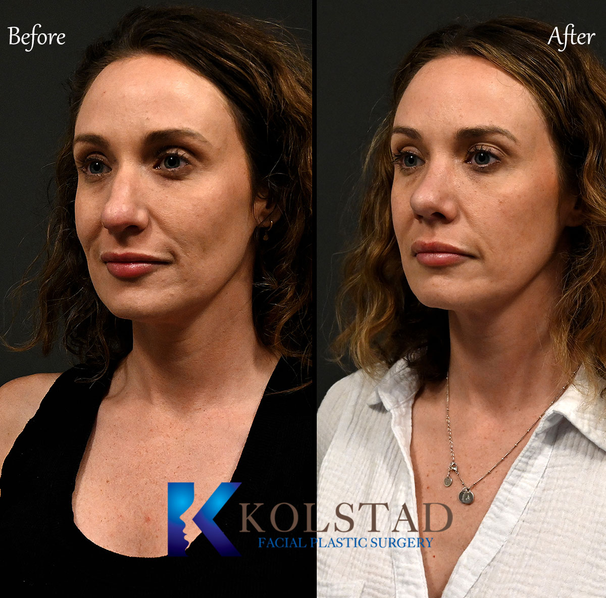 best ultrasonic rhinoplasty before and after