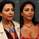 neck lift san diego