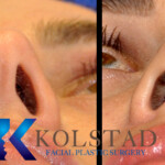rhinoplasty scar example 150